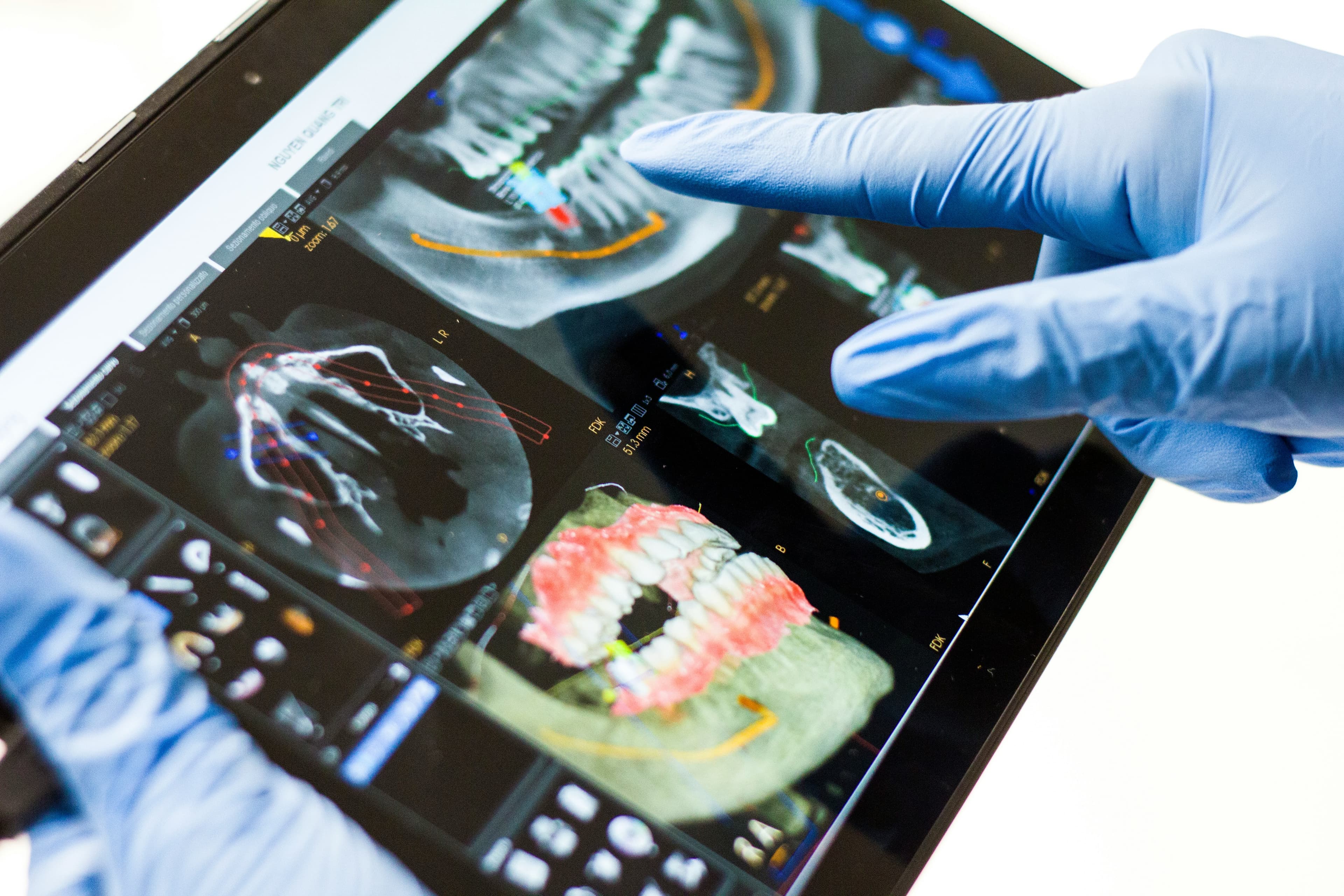 Behandler zeigt auf einem Tablet die 3D-Röntgenaufnahme (DVT) des Kiefers zur Implantat- und Knochenplanung - Zahnarztpraxis Dr. Salem in Krefeld-Traar
